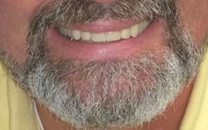 dentures meridian idaho