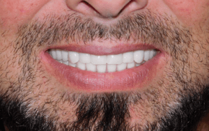 mens dentures