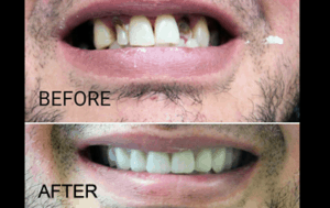 denture patient before and after