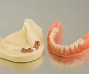 implant dentures in Meridian