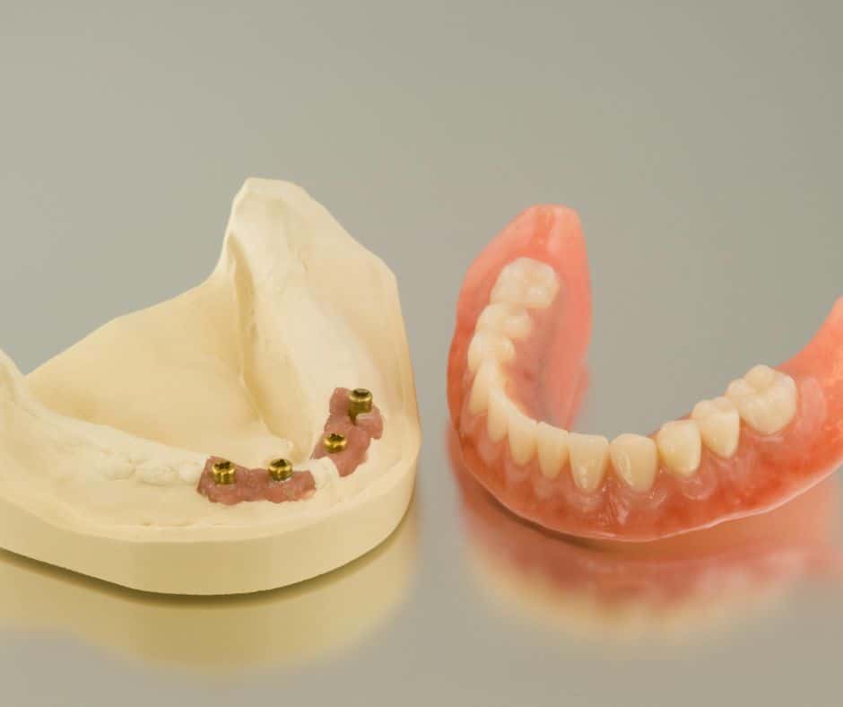 Implant Dentures - Premier Dentures