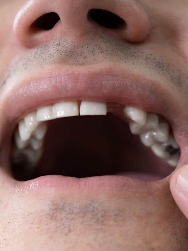 partial dentures in meridian