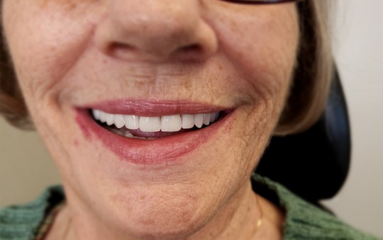 smiling lady with dentures