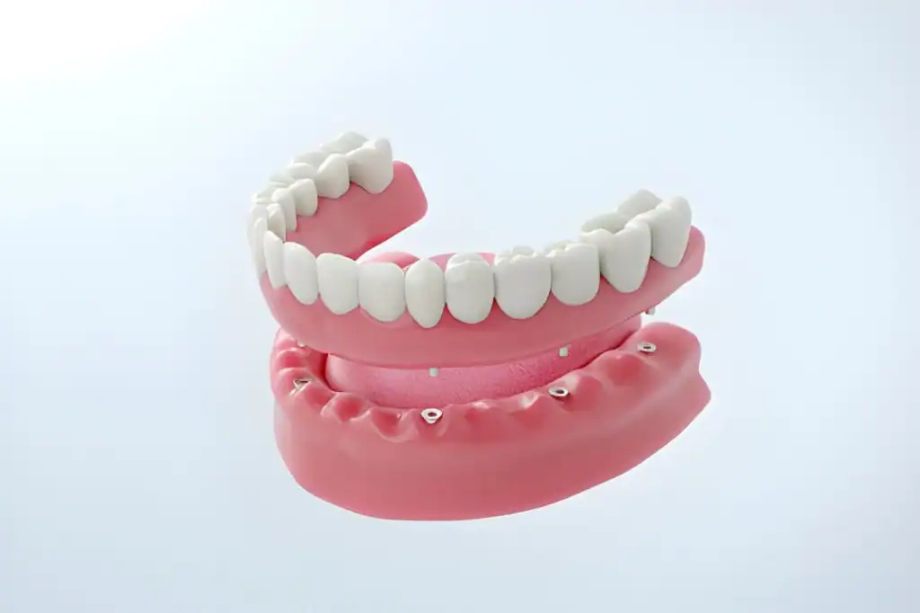 Implant-supported denture model showing removable teeth attached to lower jaw implants